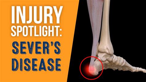 youtube calcaneal compression test|calcaneal apophysitis sever disease.